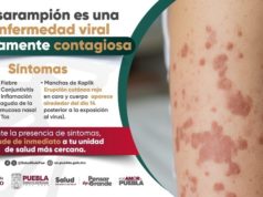Puebla registra 33 casos confirmados de sarampión; suman 121 probables