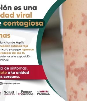 Puebla registra 33 casos confirmados de sarampión; suman 121 probables