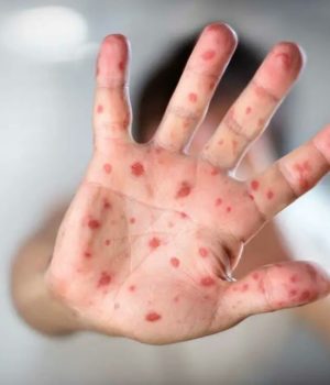 Confirman 28 casos de sarampión en Puebla; descartan que menor fallecido fuera residente del estado